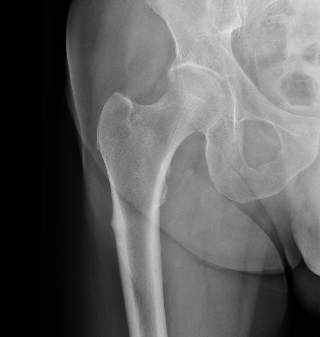 Atypical femur fracture xray
